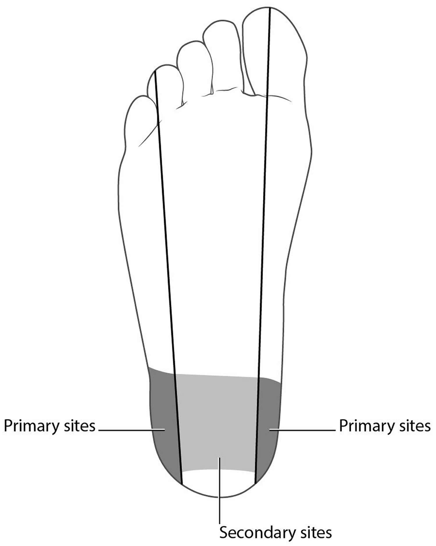 Newborn heel stick procedure, location.indications, contraindications ...