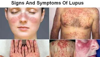 Systemic lupus erythematosus