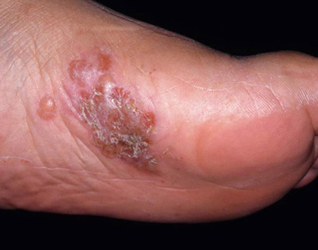 Tinea Pedis Athlete S Foot Causes Symptoms Diagnosis Treatment