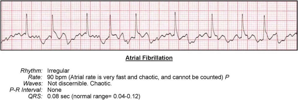 Arrhythmias meaning, causes, symptoms, diagnosis, ecg & treatment