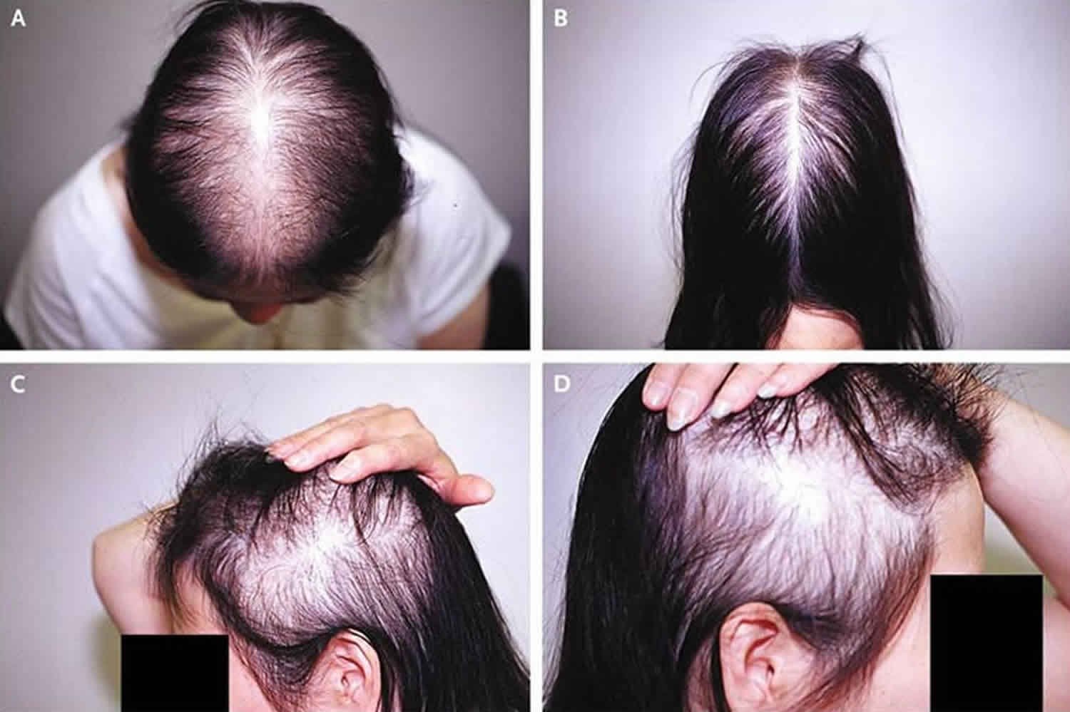Hair loss in women, causes, prevention, diagnosis & best treatment for hair  loss