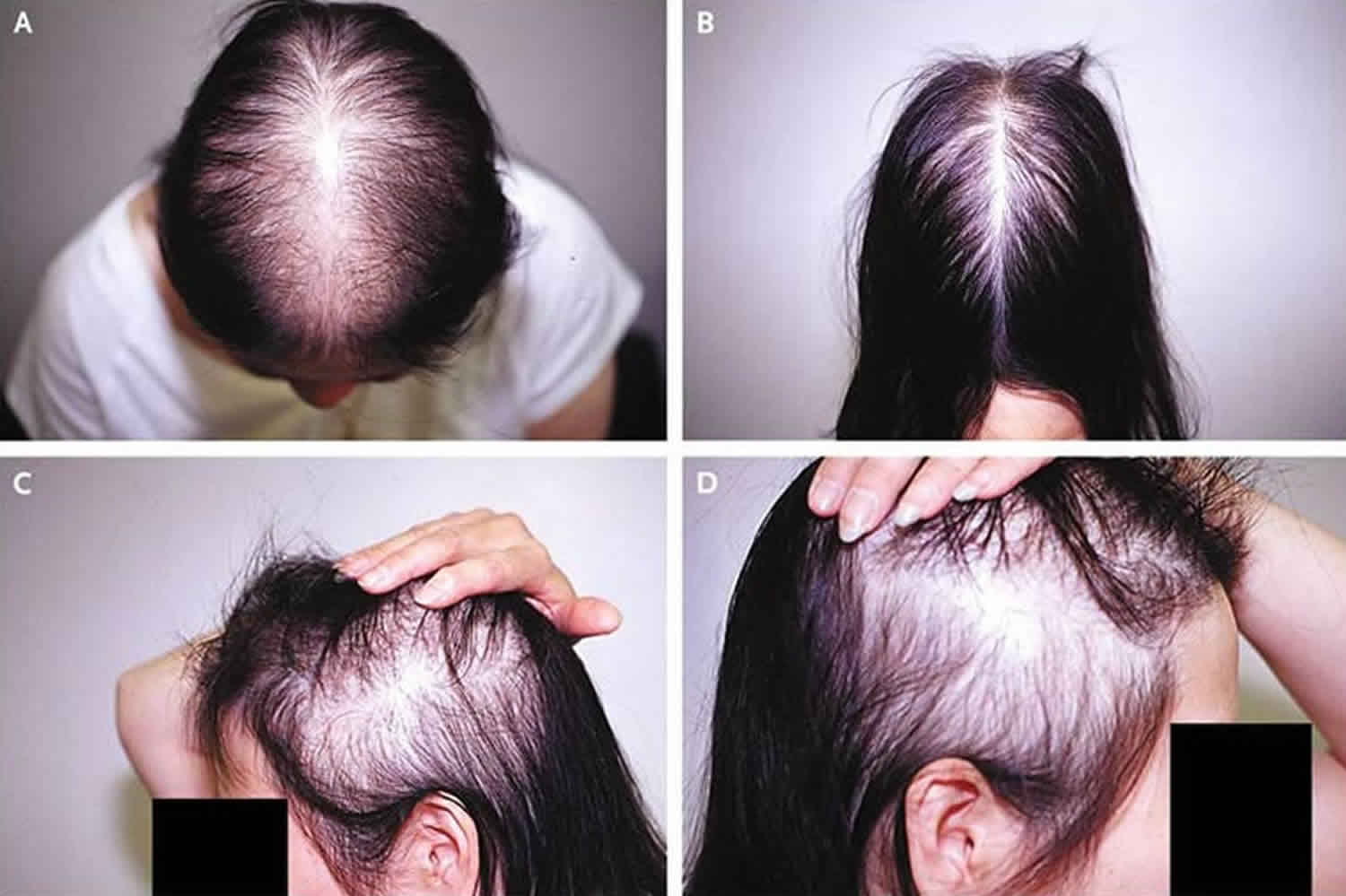 Hair Loss Symptoms Causes and Treatment