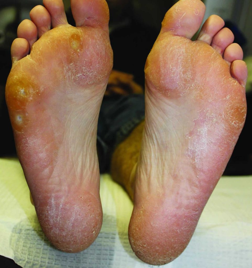Tinea Pedis Athlete S Foot Causes Symptoms Diagnosis Treatment