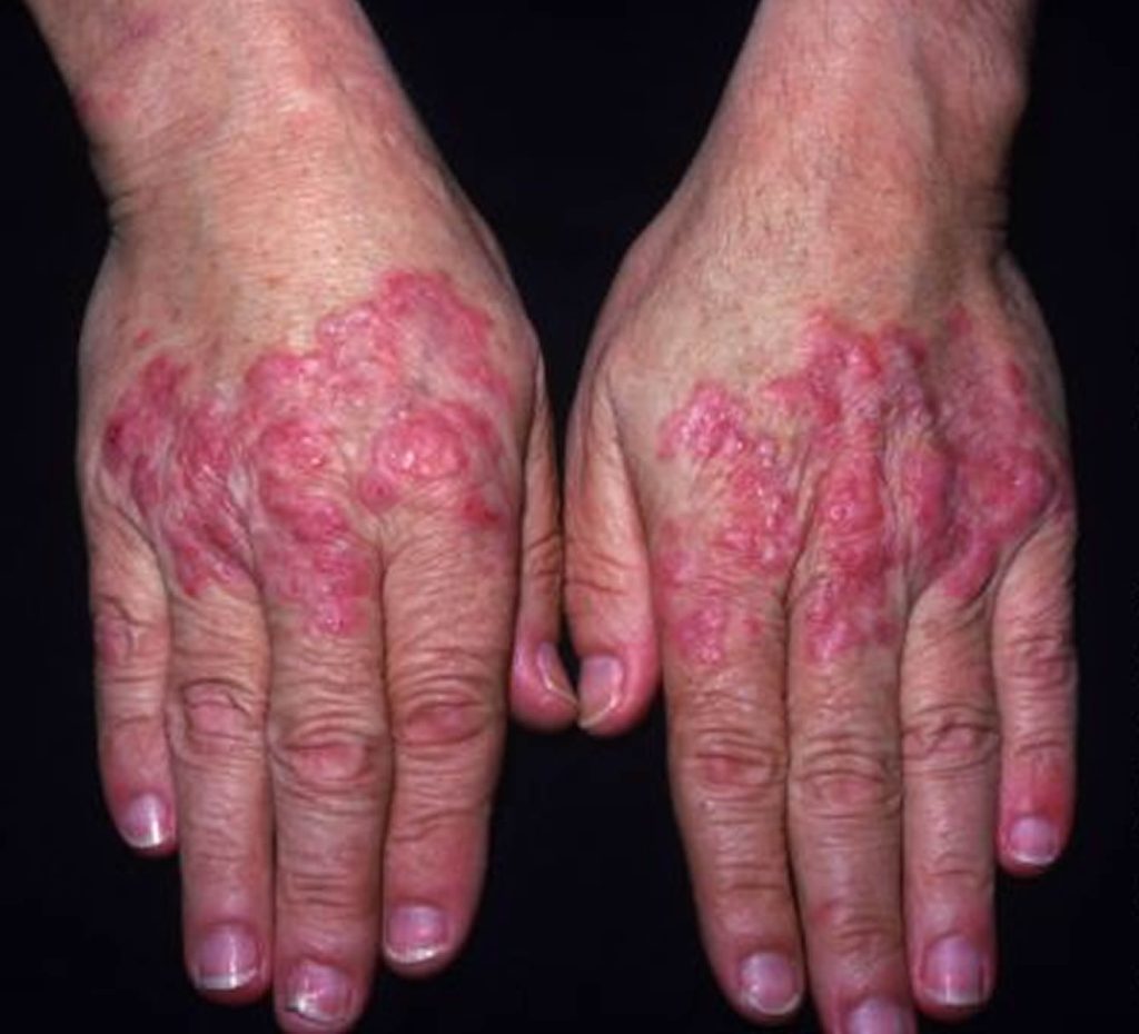 Systemic lupus erythematosus causes symptoms diagnosis treatment