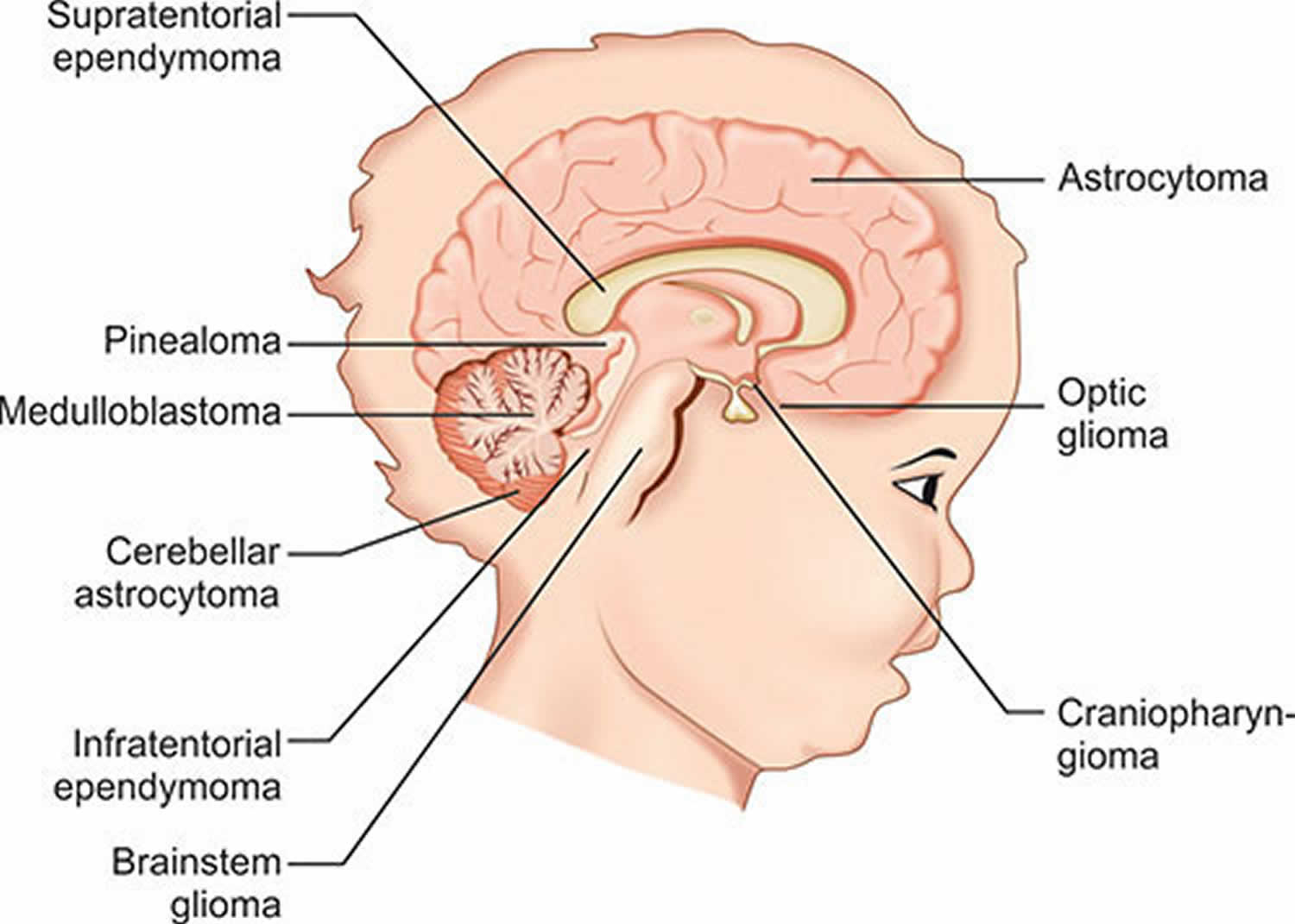 Brain Tumor In Children Causes Symptoms Diagnosis Treatment 