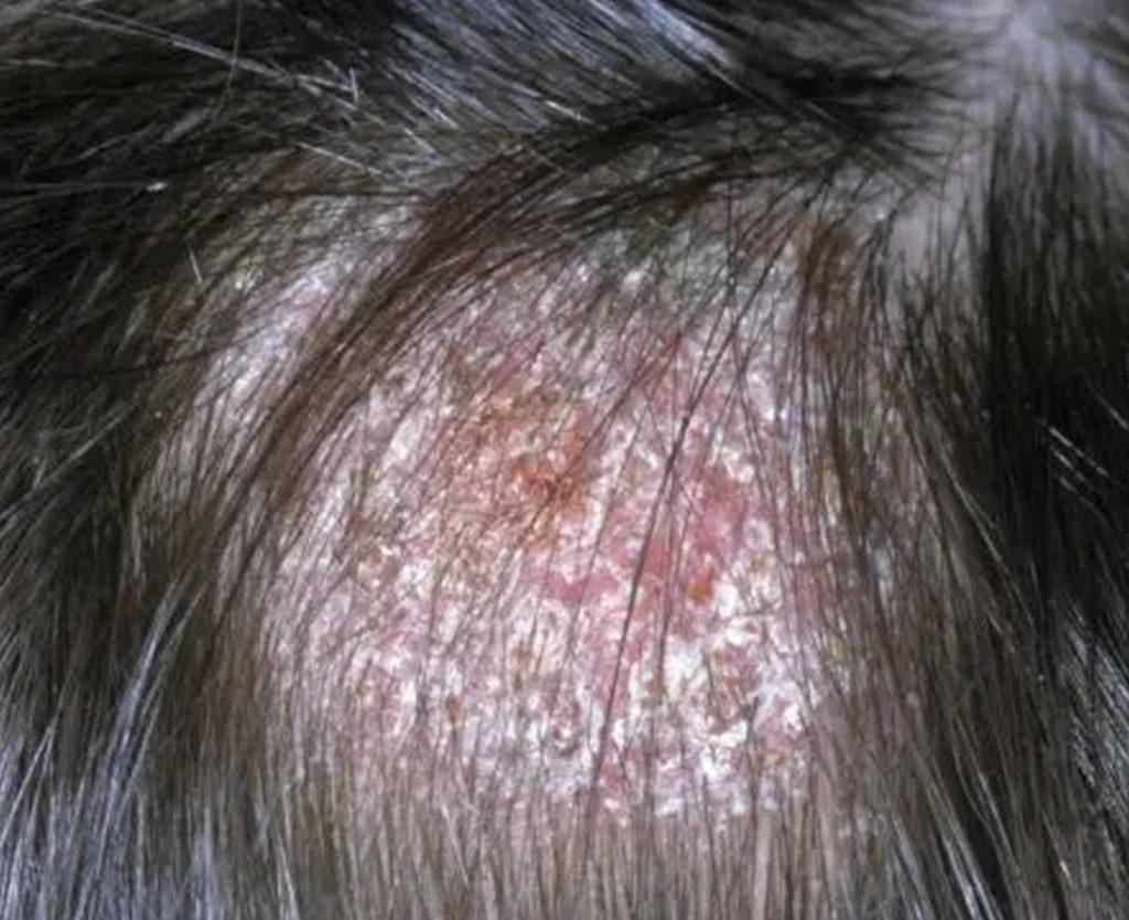 Ringworm, tinea, causes, signs, symptoms, diagnosis & treatment