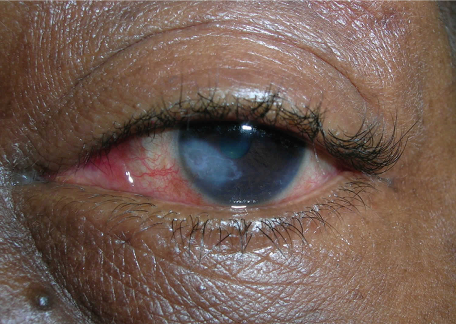 Herpetic keratitis with corneal scarring
