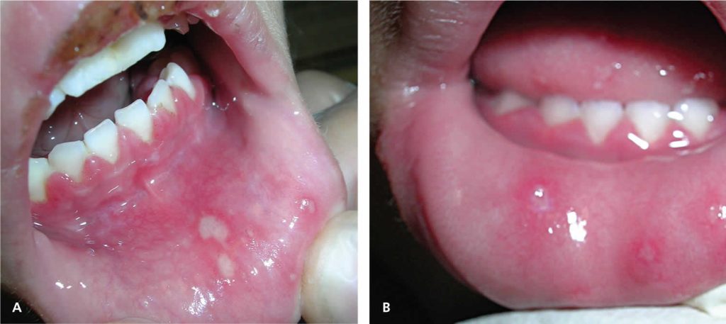 oral-herpes-causes-signs-symptoms-diagnosis-treatment-prognosis