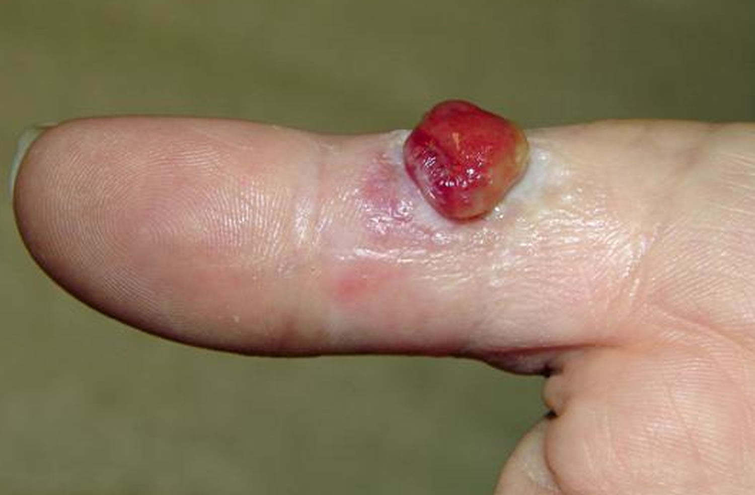 Pyogenic granuloma finger