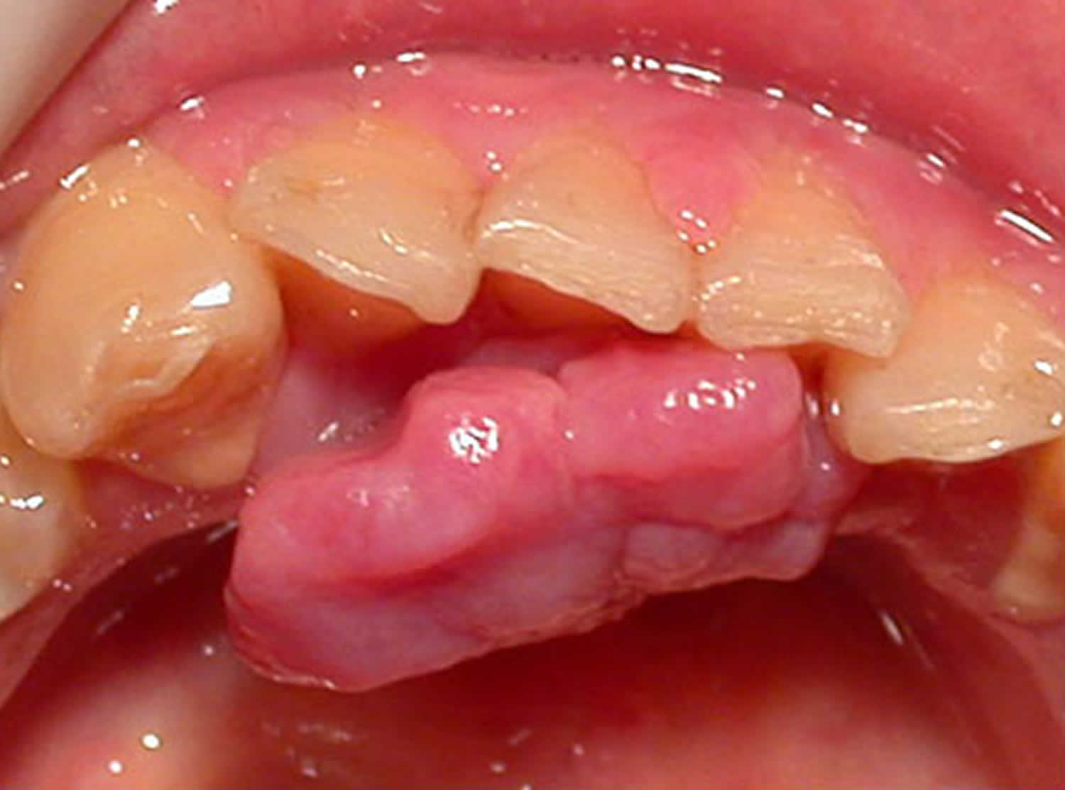 Pyogenic granuloma gums