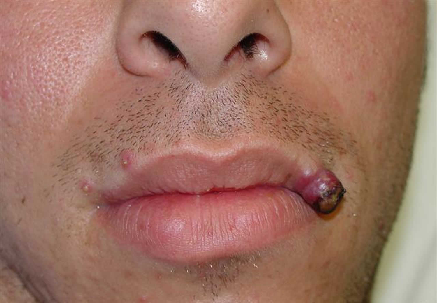 Pyogenic granuloma lip