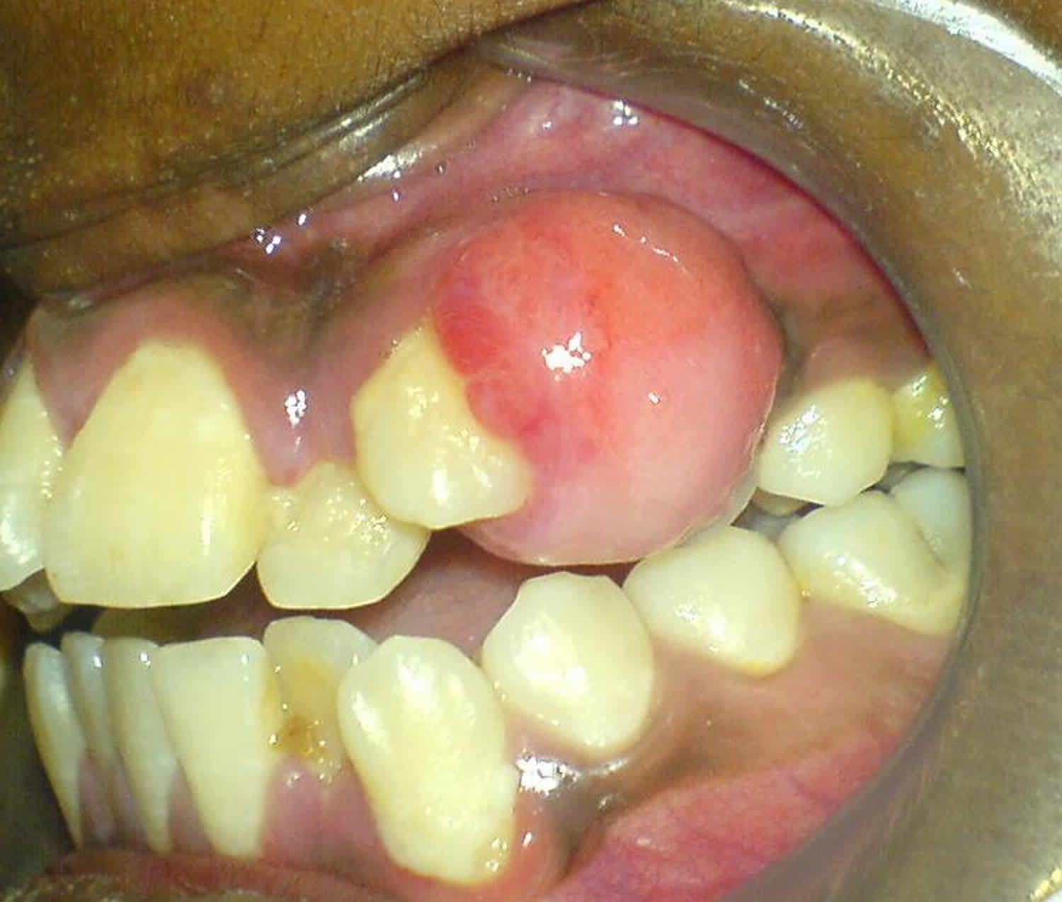 Pyogenic granuloma mouth