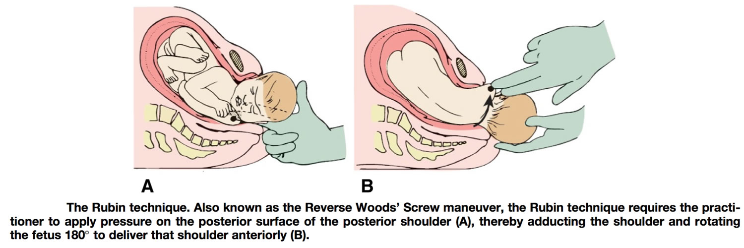 shoulder dystocia woods screw maneuver