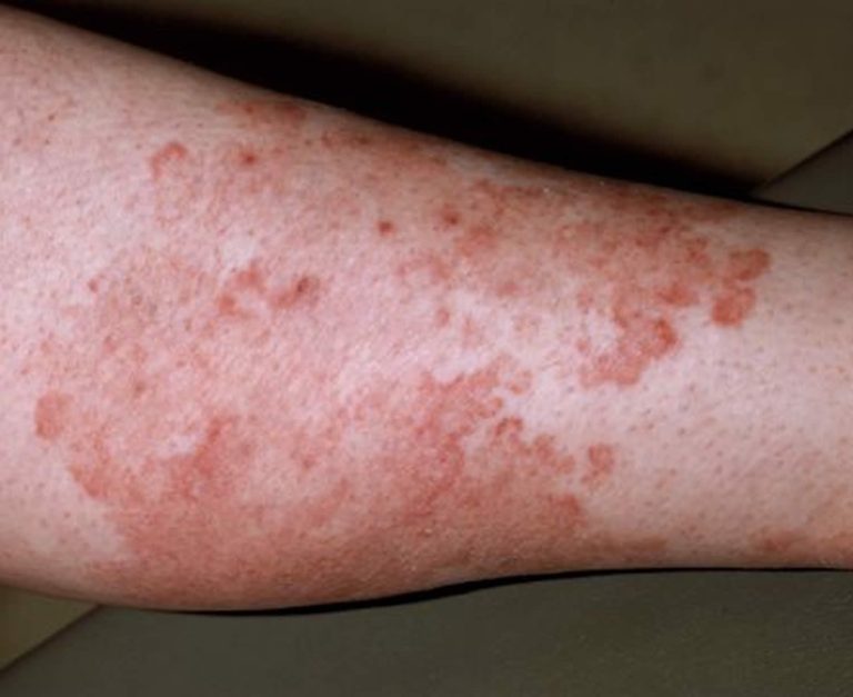 Ringworm, tinea, causes, signs, symptoms, diagnosis & treatment