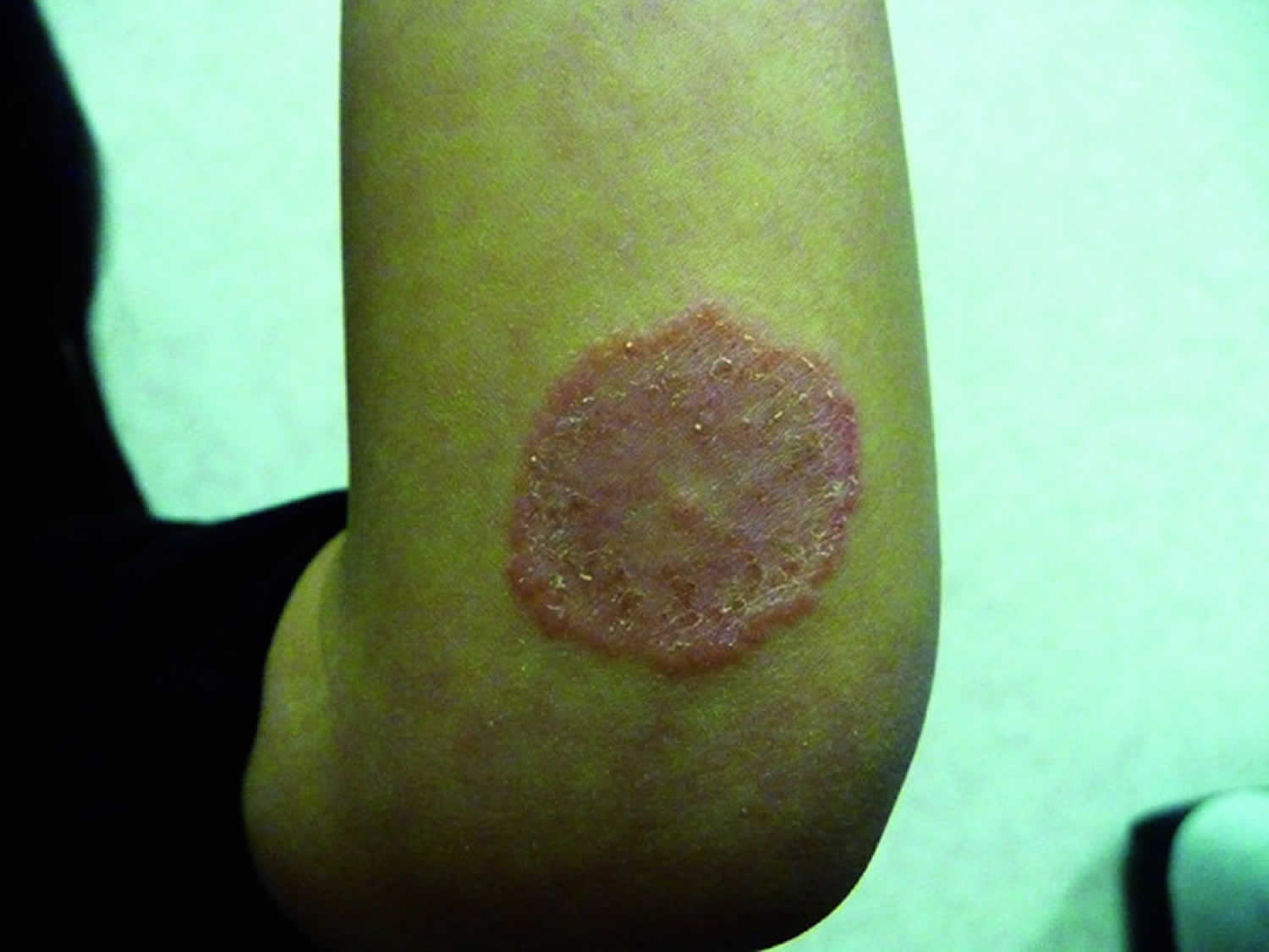 Ringworm rash