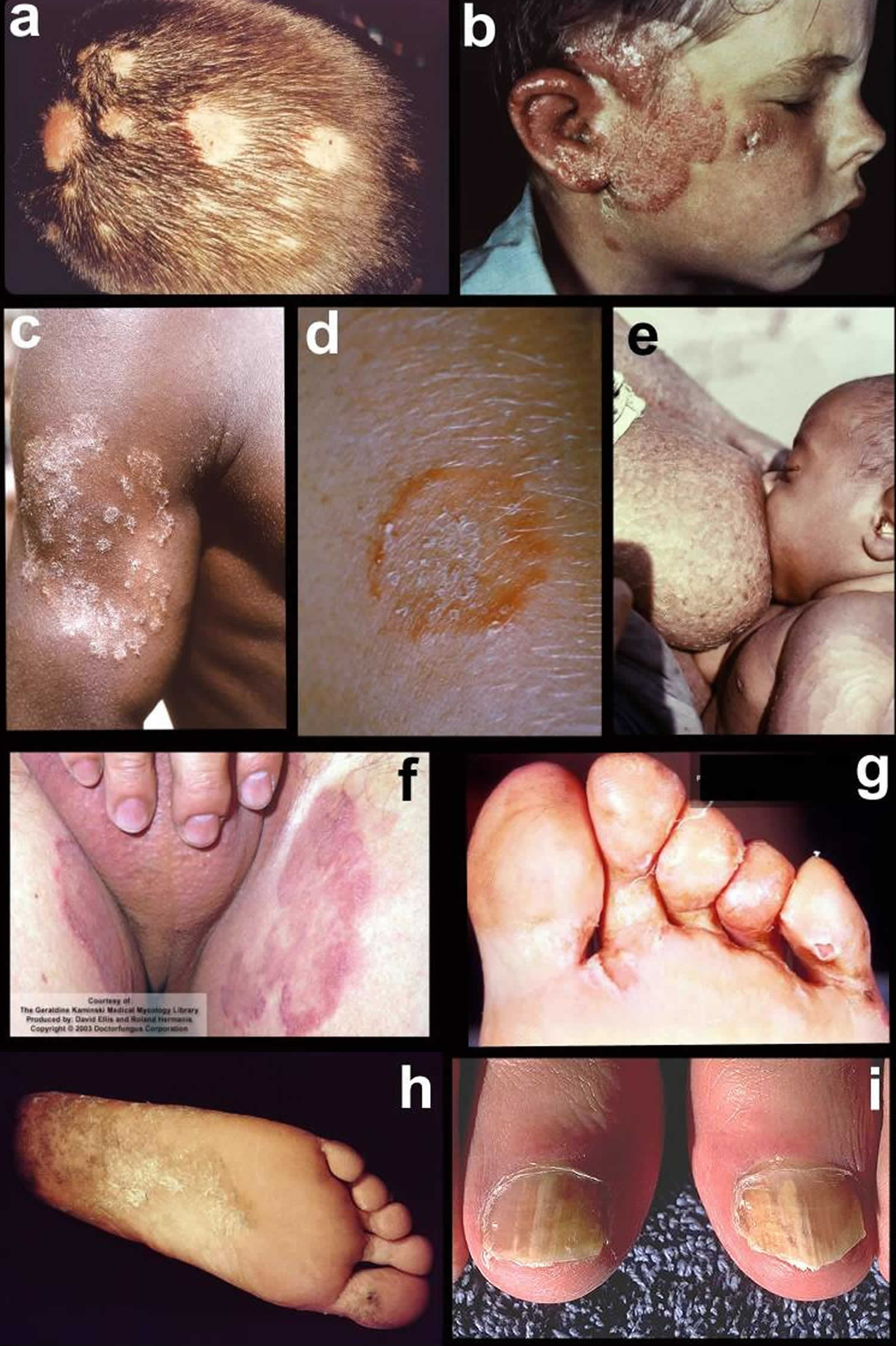 Ringworm throughout the body