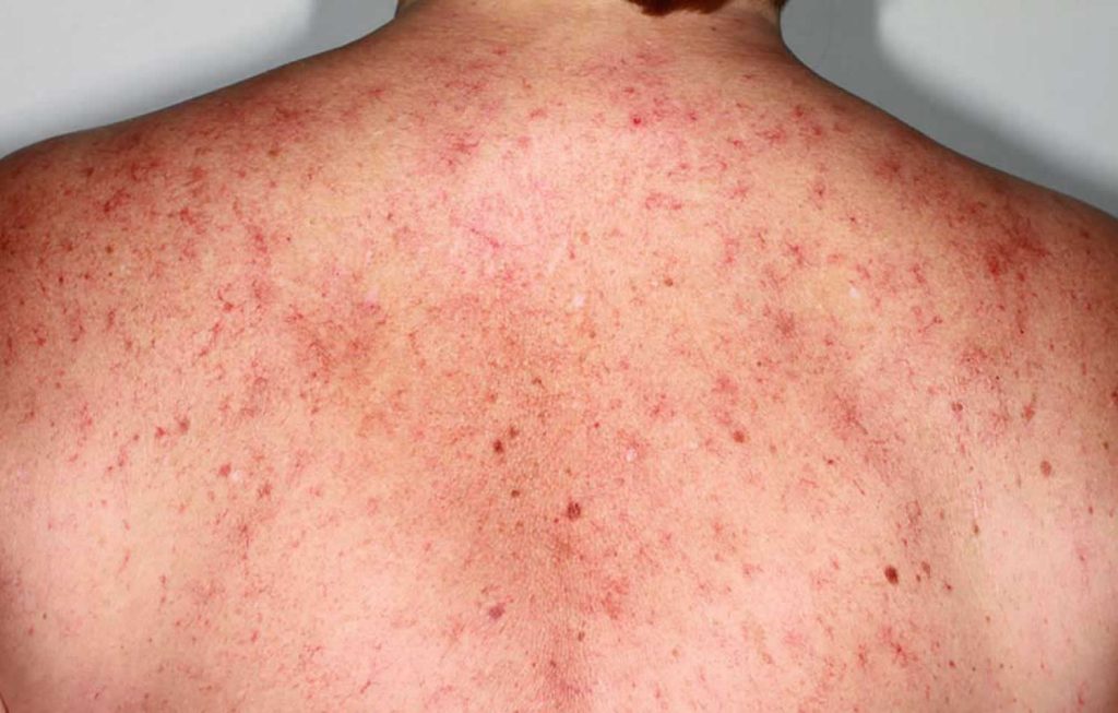 spider-angioma-causes-symptoms-diagnosis-spider-angioma-treatment