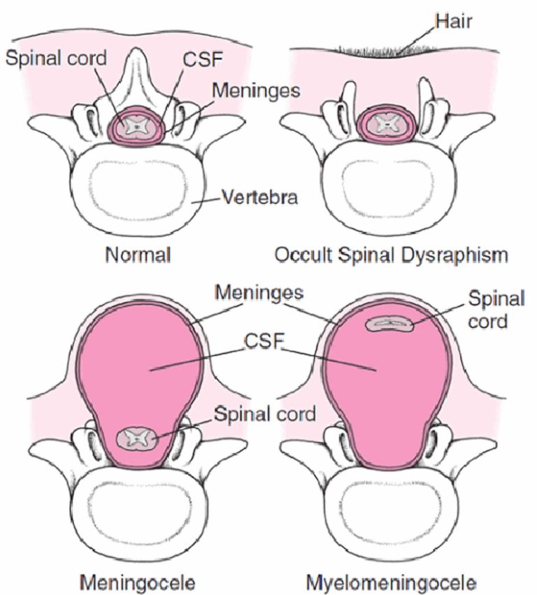 Spinal dysraphism, causes, types, symptoms, diagnosis, prognosis