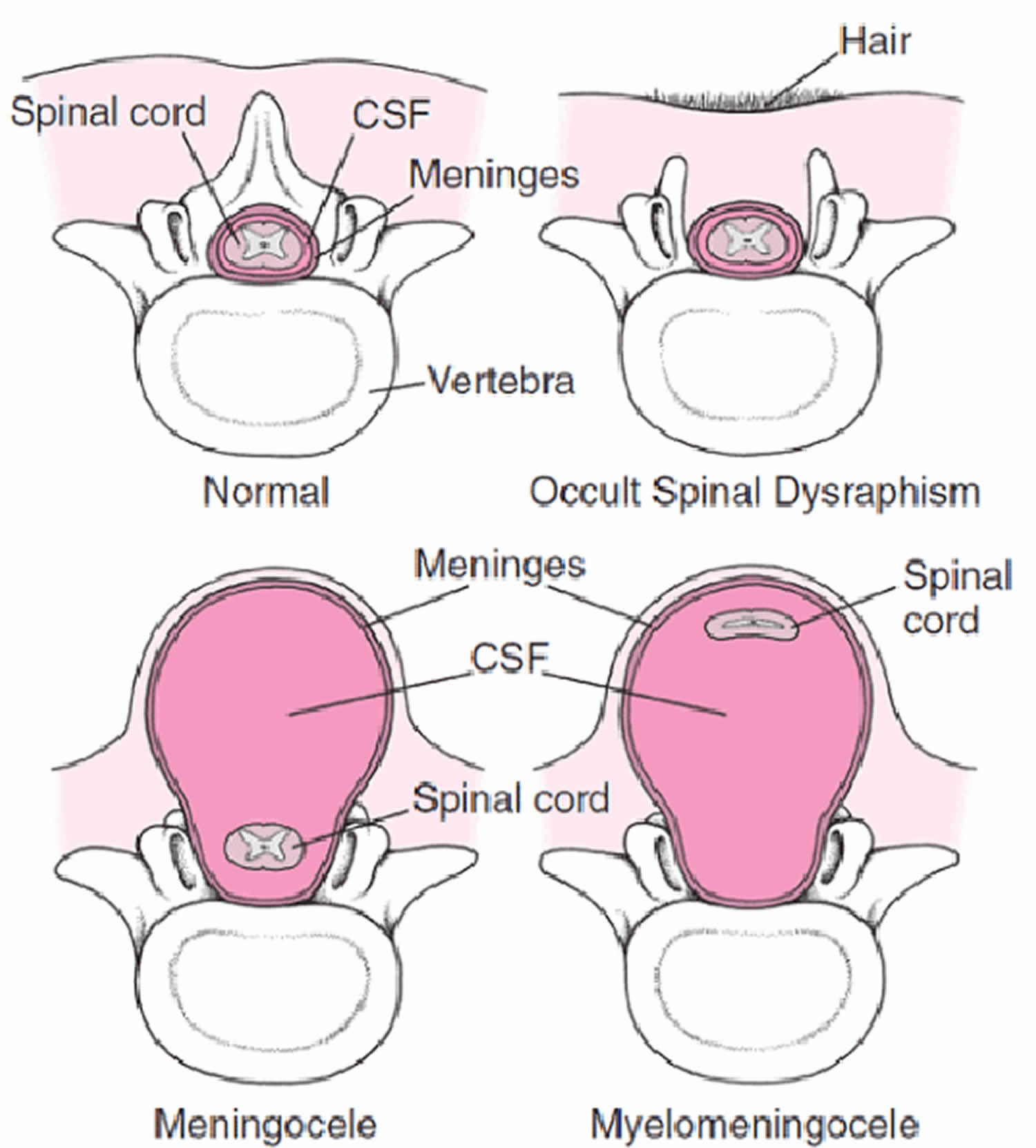 spinal dysraphism types