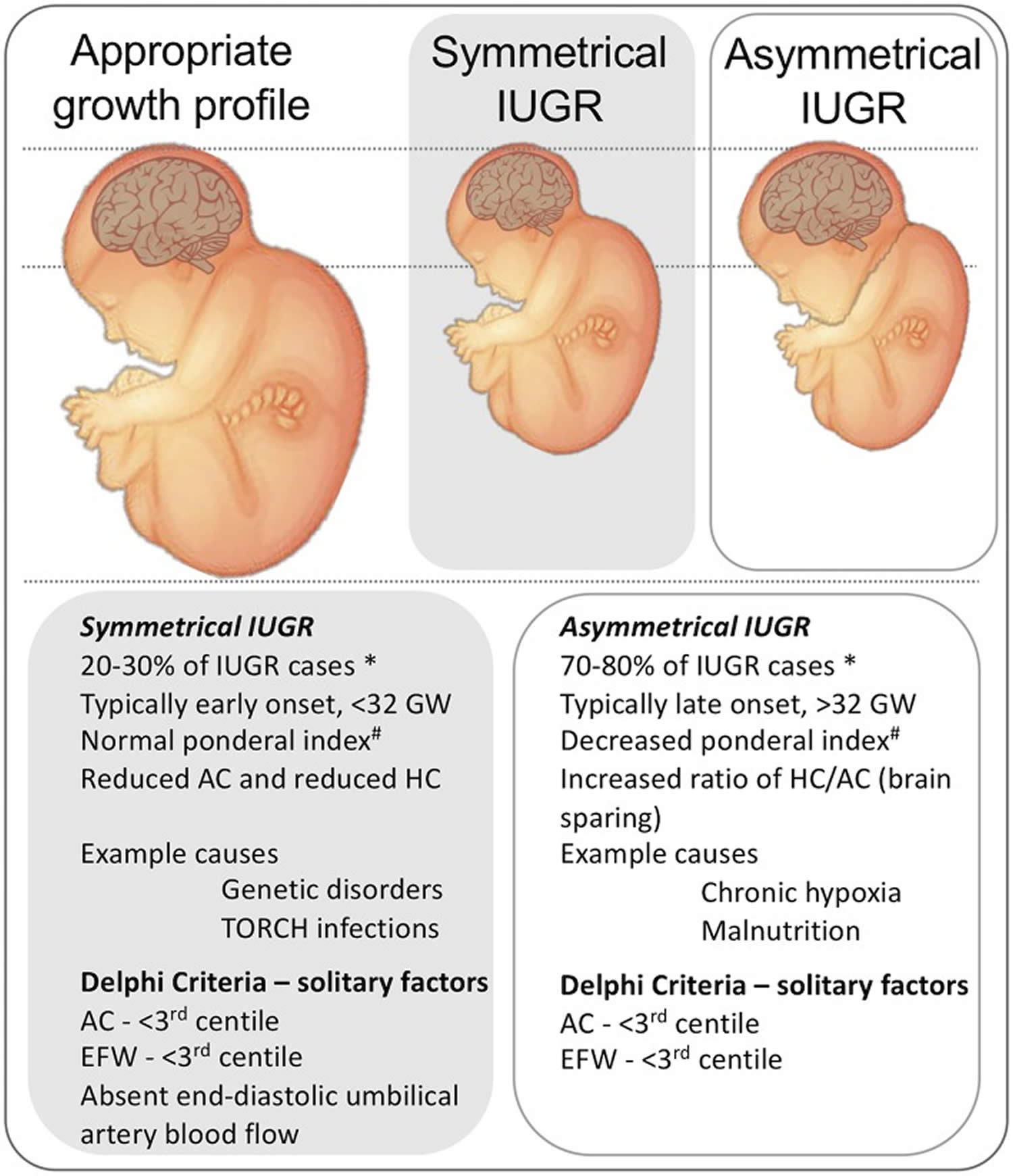 Intrauterine Growth Restriction Causes Symptoms Diagnosis Treatment And Prognosis 8274