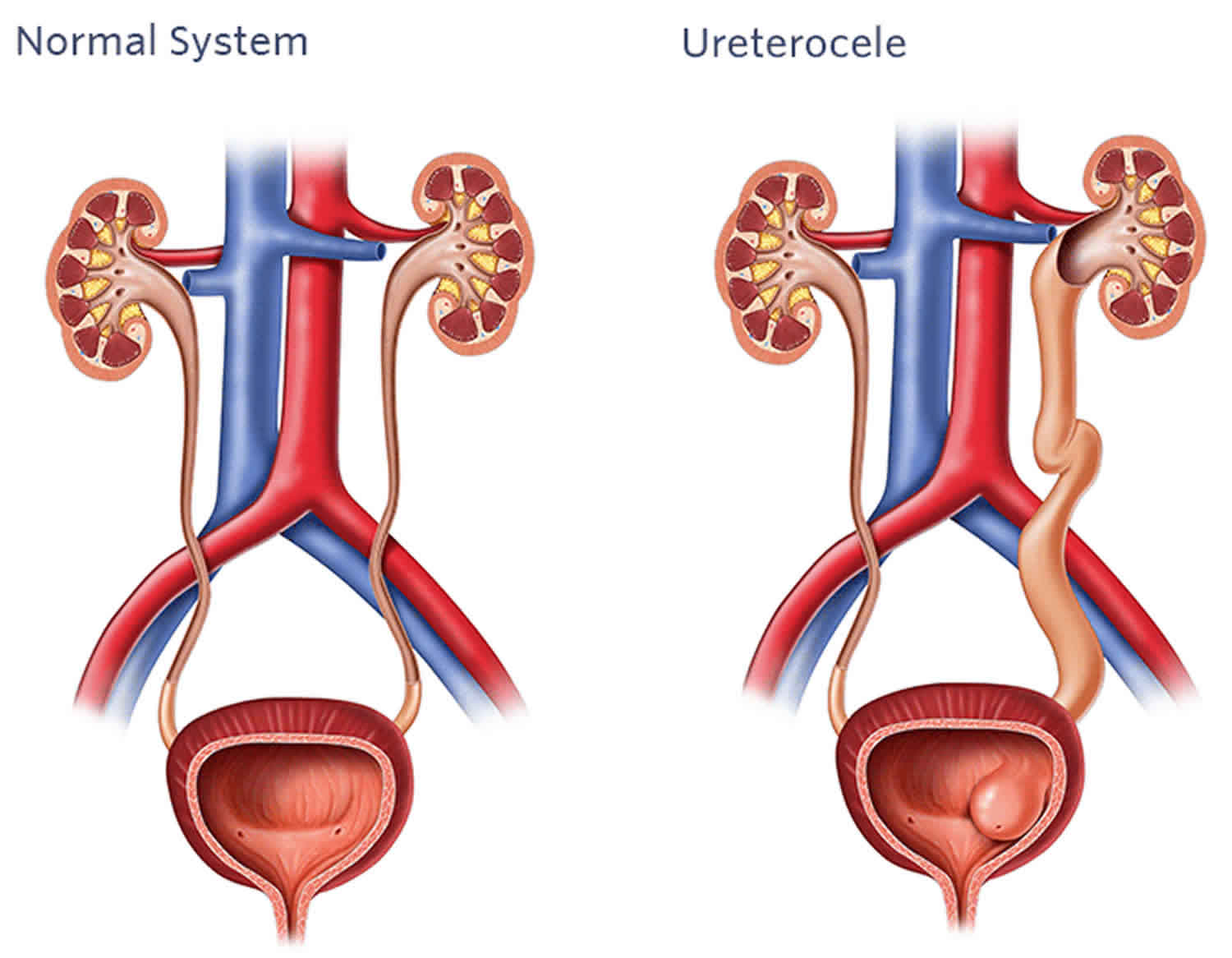 Ureterocele