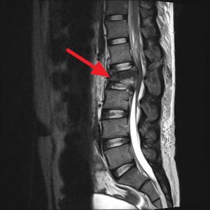 Cauda equina syndrome, causes, signs, symptoms, diagnosis, treatment ...