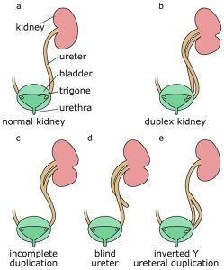 Duplex kidney causes, symptoms, diagnosis & treatment