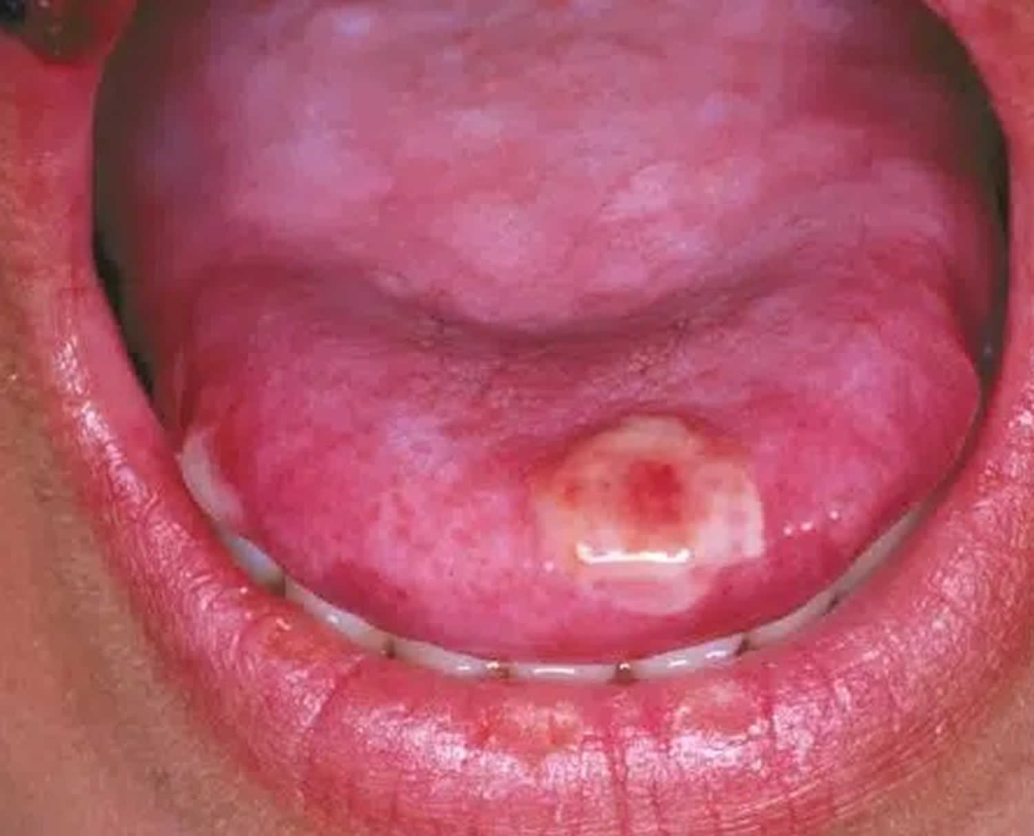 oral herpes tongue