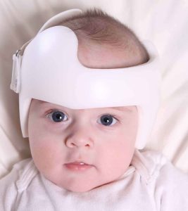 Plagiocephaly causes, symptoms, diagnosis & treatment