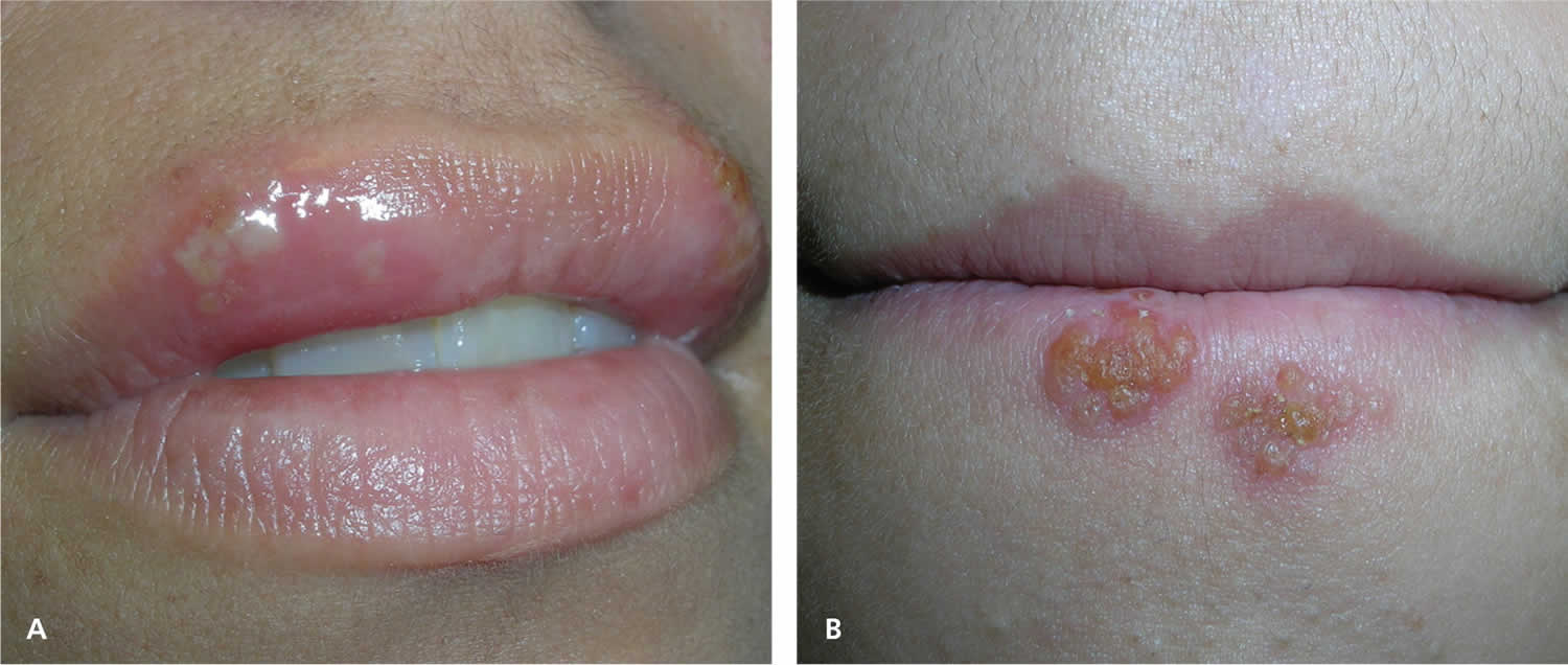 Recurrent cold sore on lip