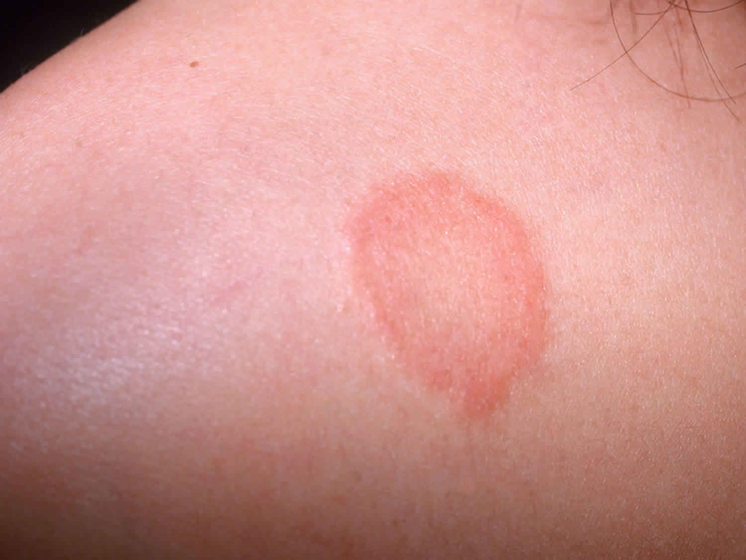 Ringworm Tinea Causes Signs Symptoms Diagnosis Treatment