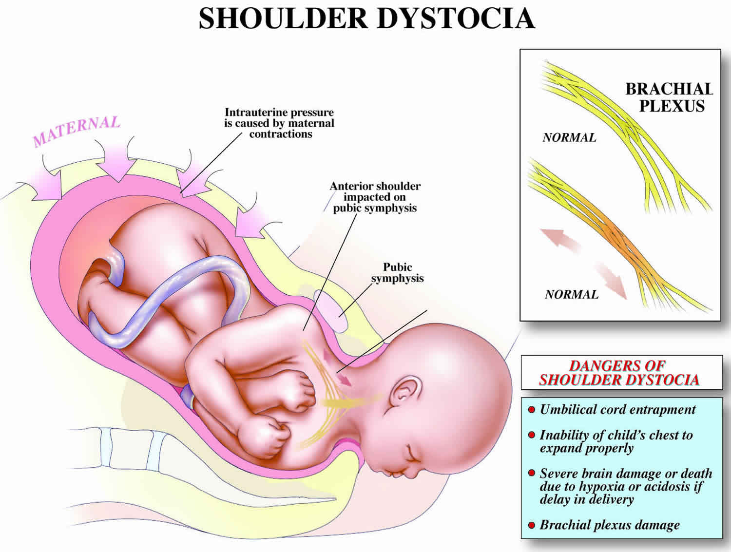 Shoulder Dystocia Causes Signs Diagnosis Treatment 54 OFF