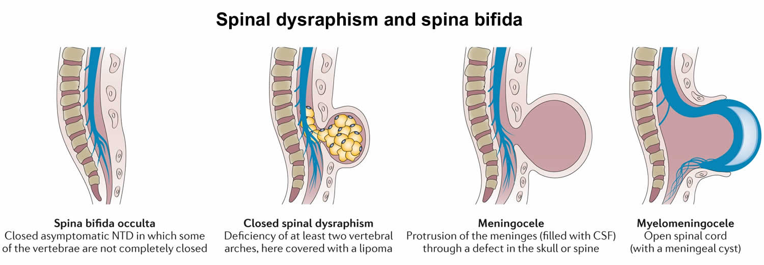 spinal dysraphism and spina bifida
