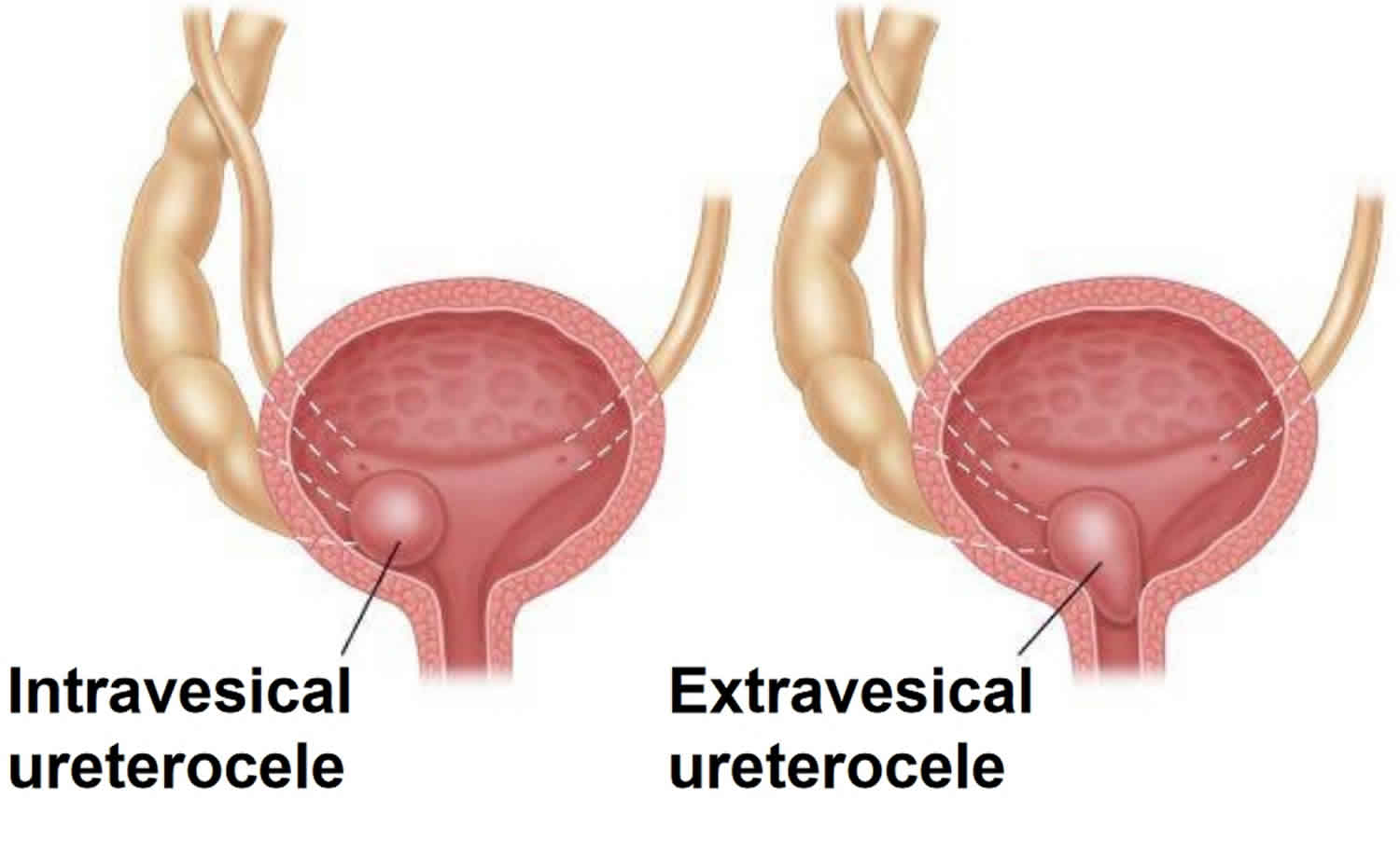Ureterocele types