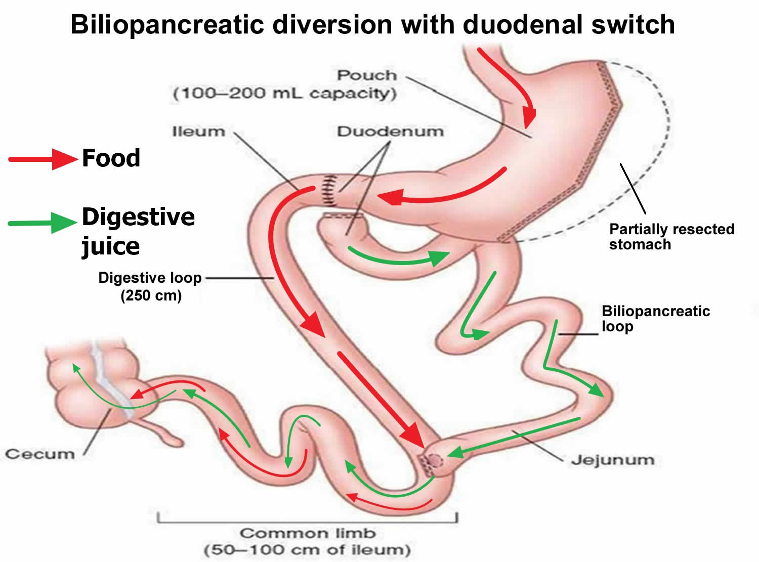 biliopancreatic-diversion-with-duodenal-switch