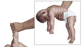 floppy infant syndrome