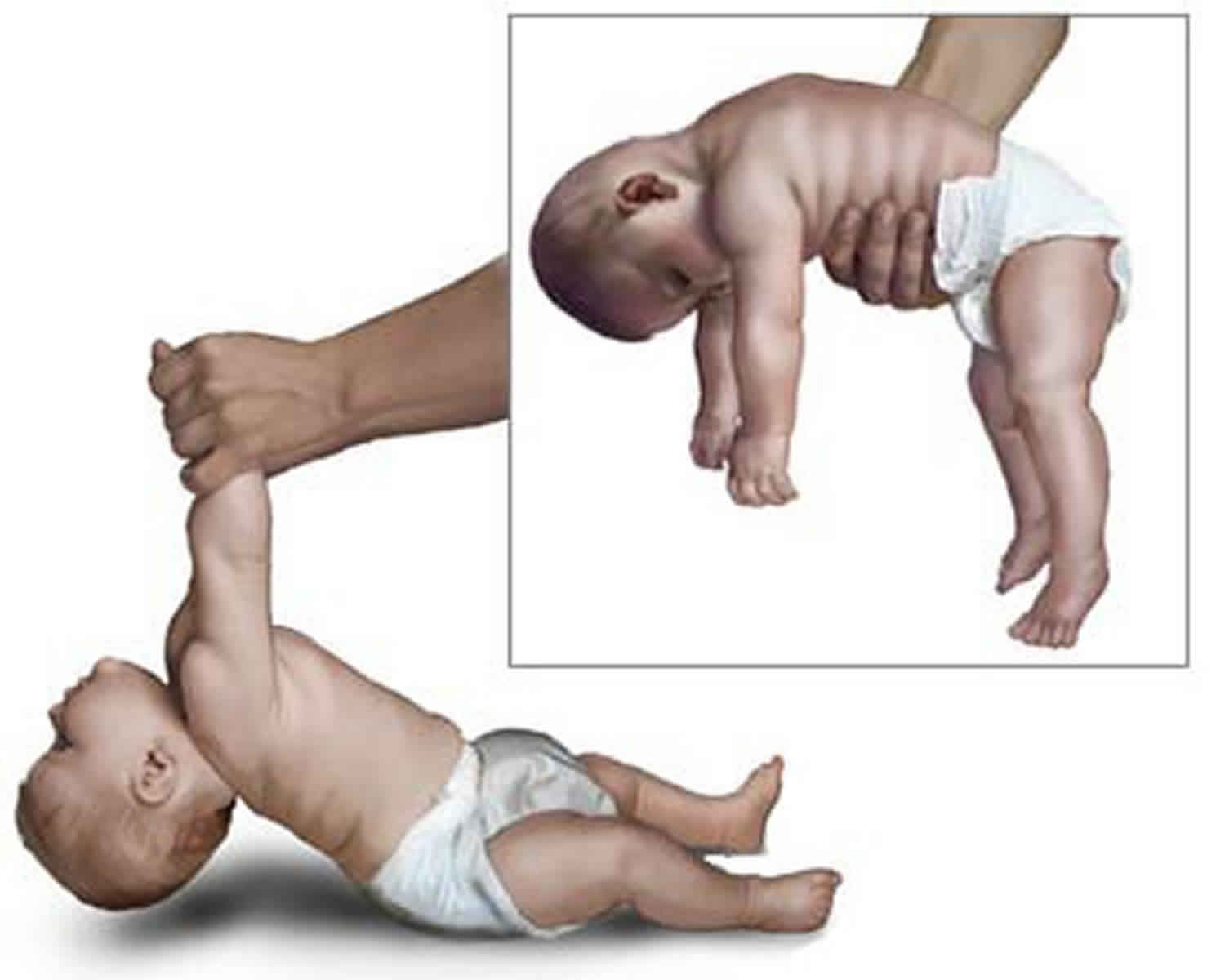 floppy infant syndrome
