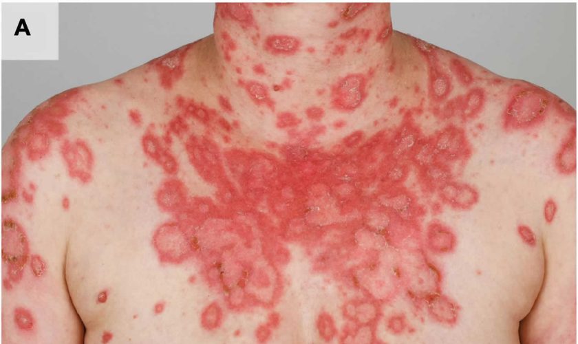 Cutaneous lupus erythematosus