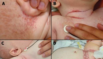 Langerhans cell histiocytosis