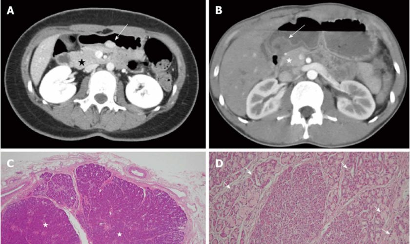 ectopic pancreas