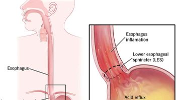 gastroesophageal reflux disease