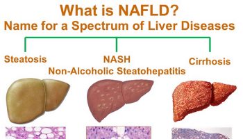 Nonalcoholic fatty liver disease