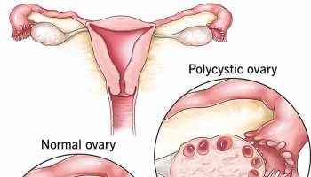 polycystic ovarian disease