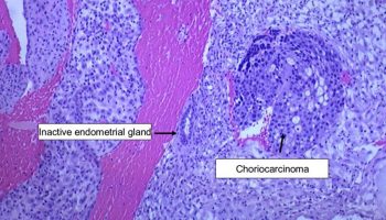 choriocarcinoma