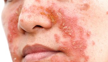 Seborrheic dermatitis