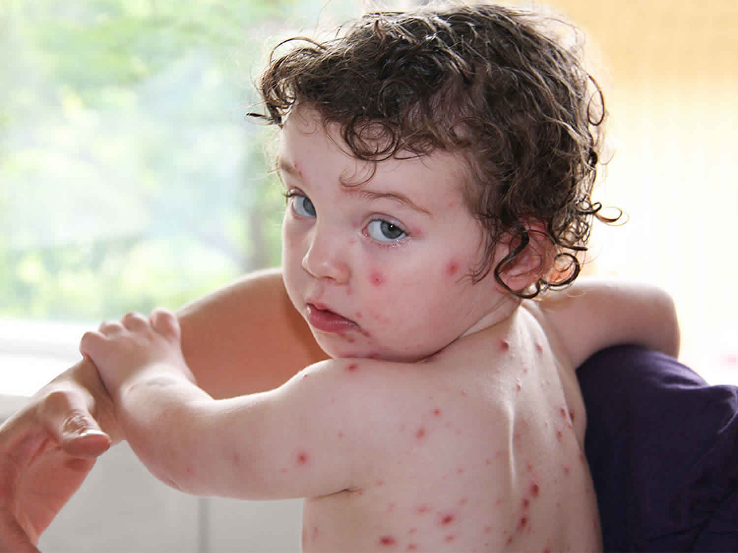 Varicella, chicken pox, causes, signs, symptoms, rash, diagnosis ...