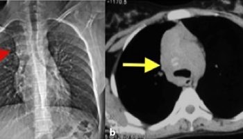 mediastinal fibrosis