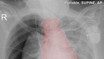 Tension pneumothorax