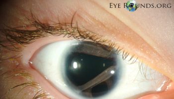 Axenfeld-Rieger syndrome eye