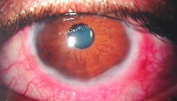 Vernal keratoconjunctivitis